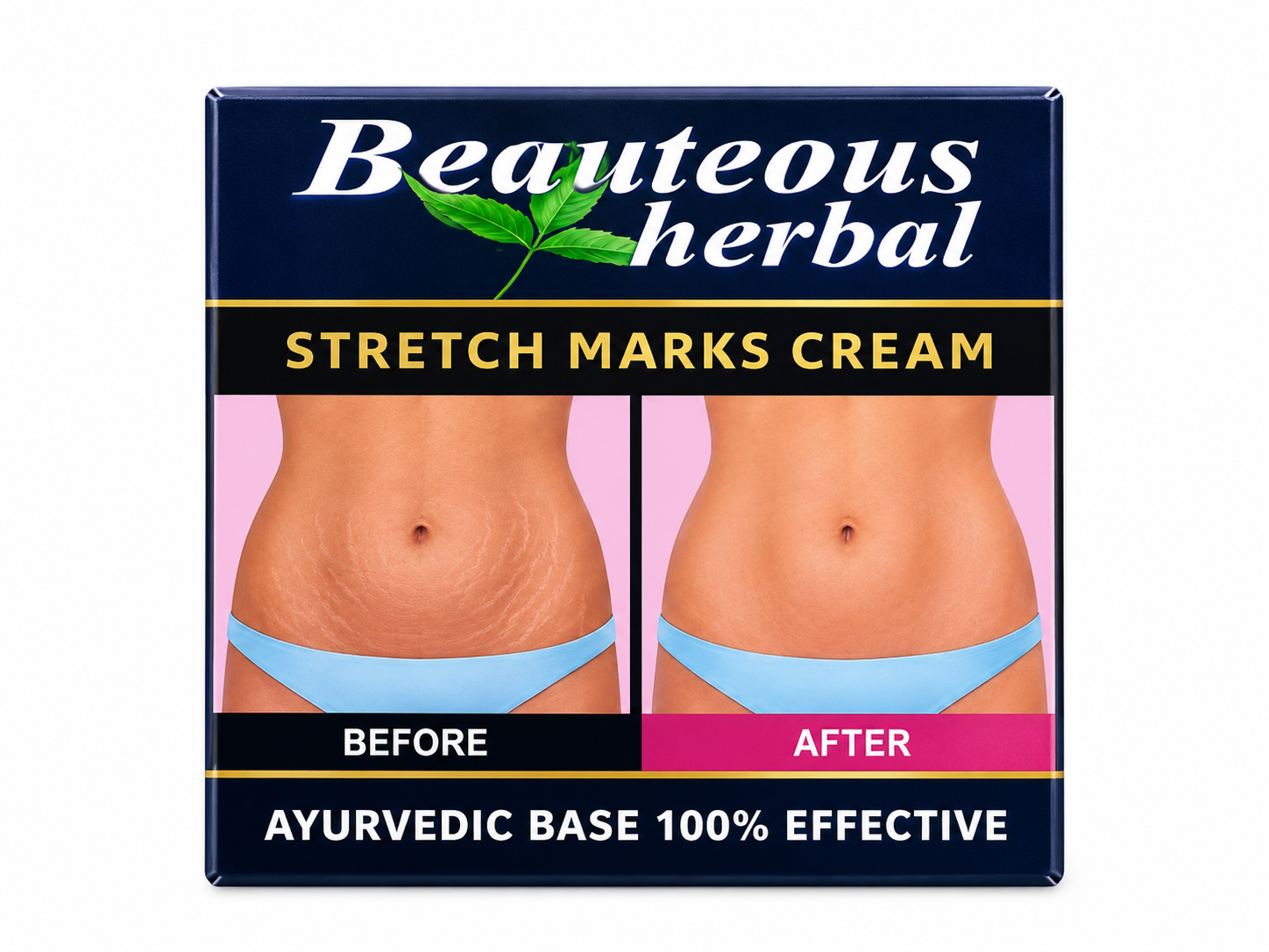 Stretch Marks Cream